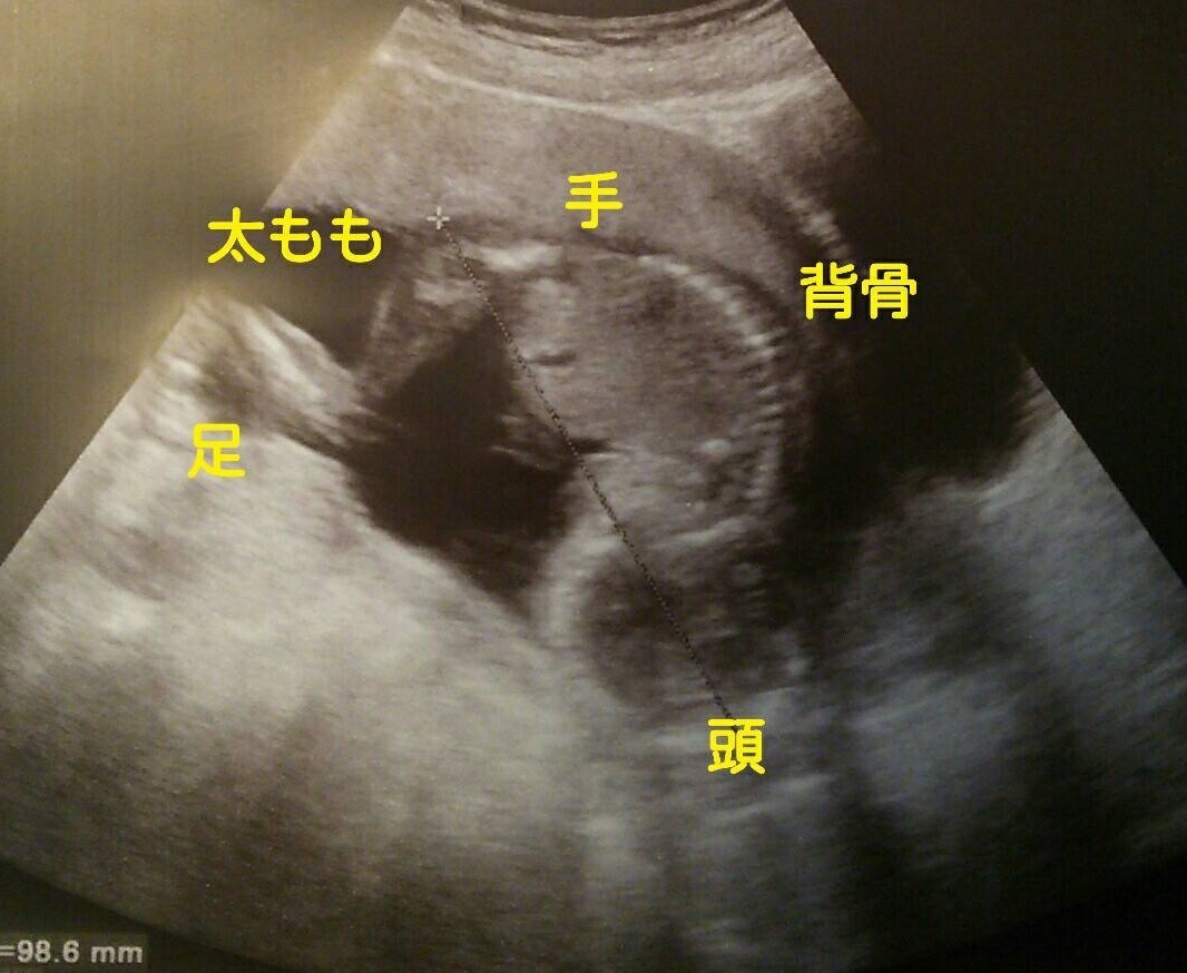 新米パパの備忘録 妊娠16週目のエコー写真